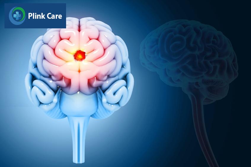 nguyên nhân gây bệnh động kinh do u não