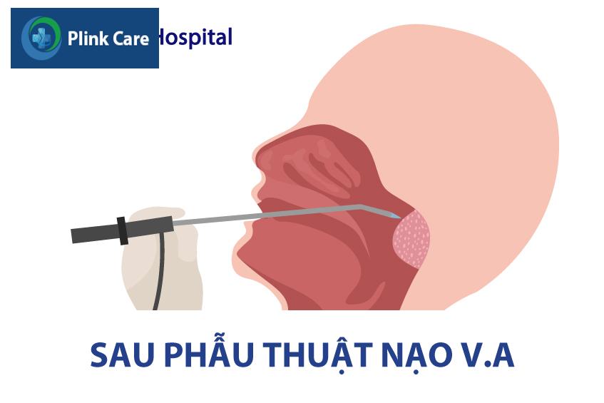 phẫu thuật nạo viêm va