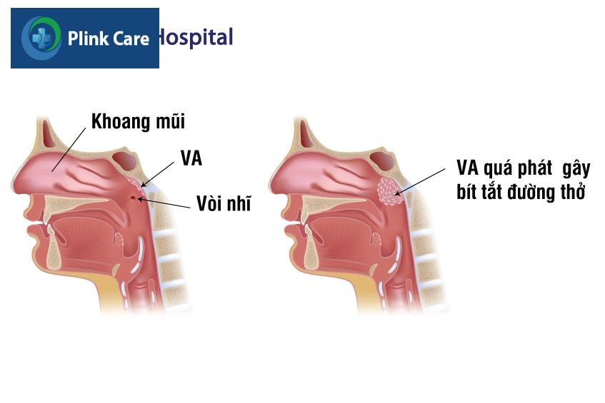 Triệu chứng viêm VA ở trẻ