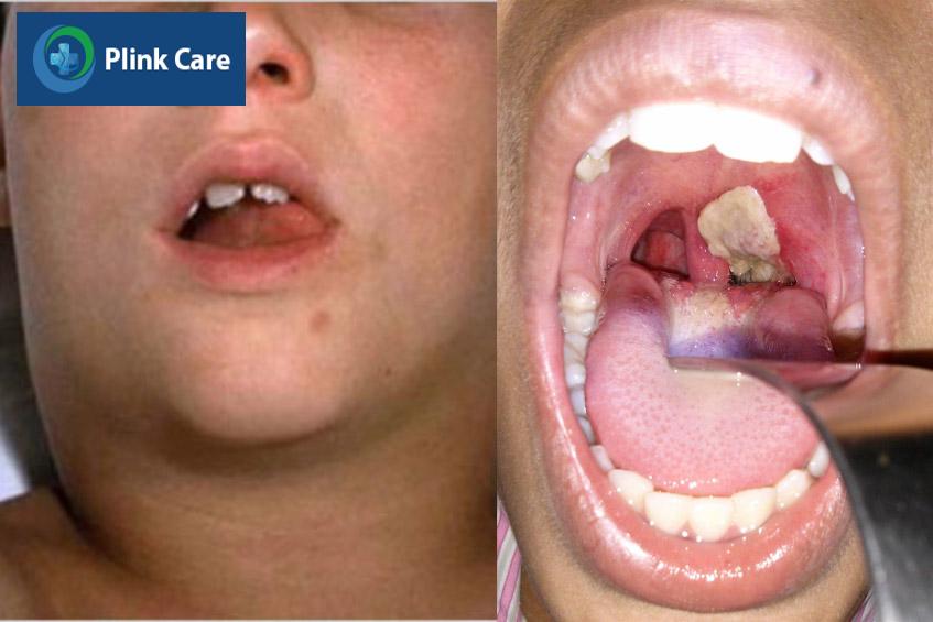 Ảnh người bệnh nhiễm bạch hầu họng