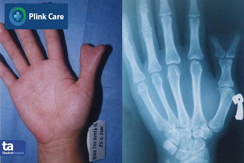 Dị tật ngón cái tách đôi