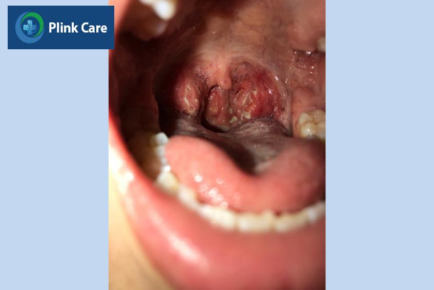 Vi khuẩn bạch hầu gây tổn thương vùng hầu họng người bệnh