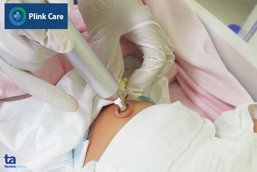 Chiếu tia plasma lạnh lên cuống rốn trẻ sơ sinh