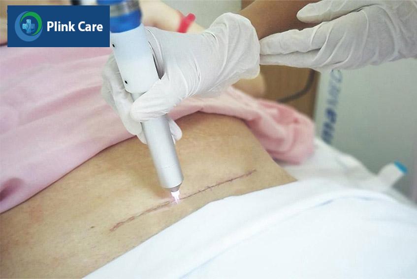tác dụng của tia plasma