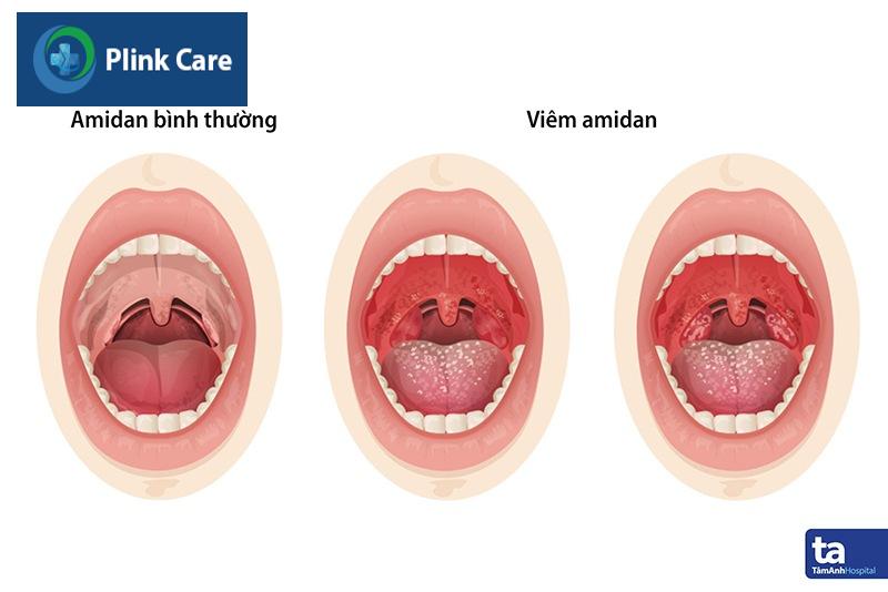 Viêm amidan mãn tính