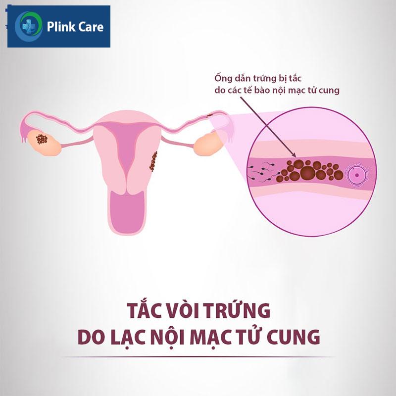 Lạc nội mạc tử cung