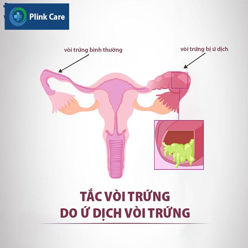 Ứ dịch vòi trứng