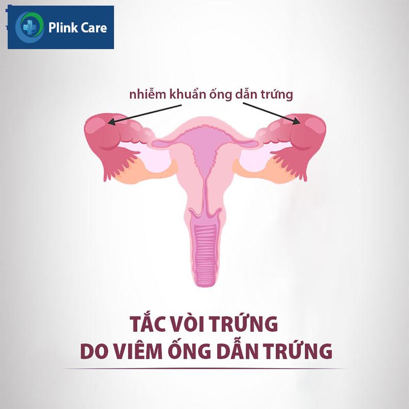 tắc vòi trứng do viêm ống dẫn trứng