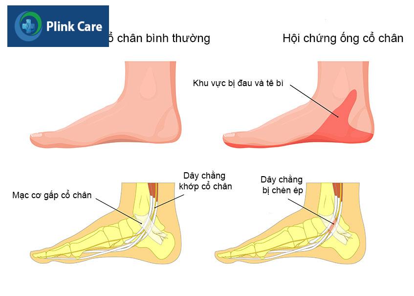 hoi chung ong co chan