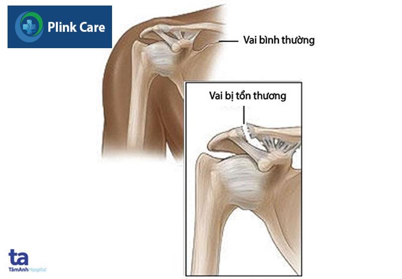 vai bi ton thuong