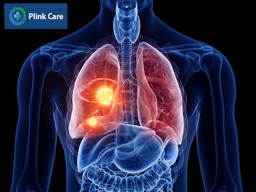 Bệnh gây ra các mô sẹo ở phổi