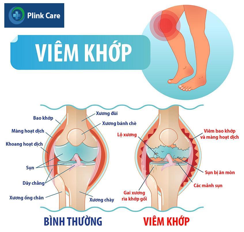 Viêm khớp gây sưng phù