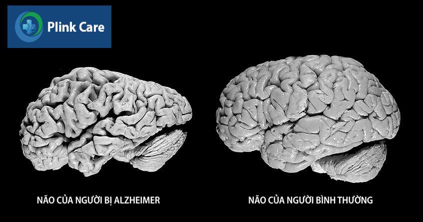 nao bo cua benh nhan alzheimer