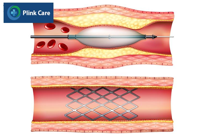dat stent dong mach vanh