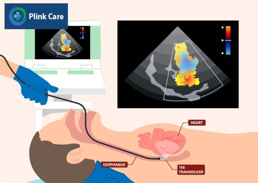 Siêu âm tim qua thực quản