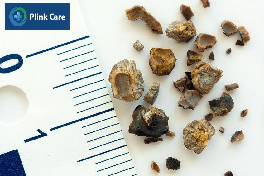 sỏi tiết niệu hình thành do đâu