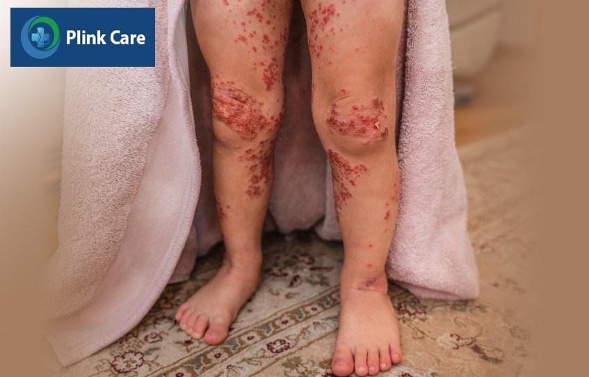 Trẻ bị bội nhiễm tại các vết loét của bệnh tay chân miệng