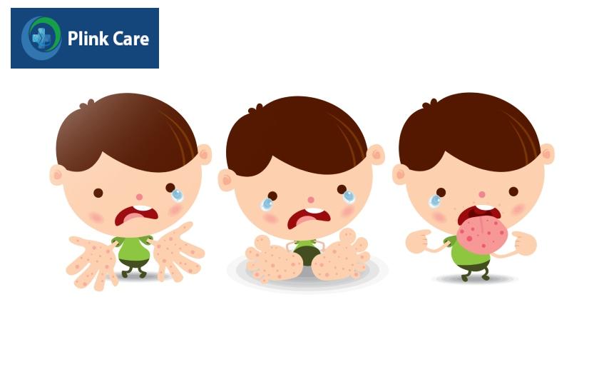 Trẻ phát ban ở tay, chân, miệng khi mắc bệnh
