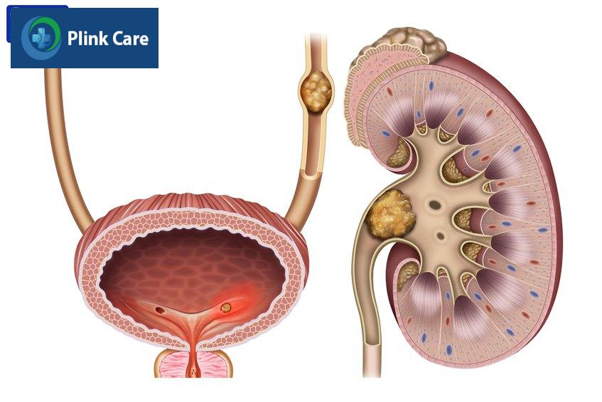 cơn đau sỏi thận là gì