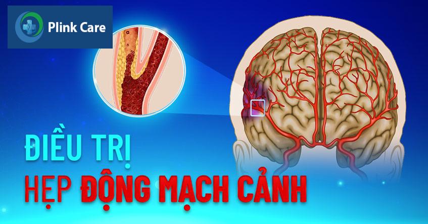 hẹp động mạch cảnh