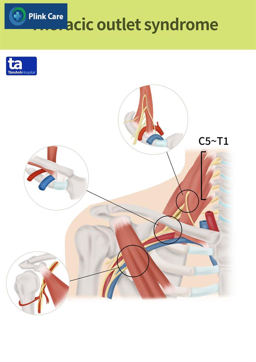 Hội chứng lối thoát lồng ngực xảy ra khi mạch/ thần kinh bị chèn ép bởi “xương” hay “phần mềm” xung quanh