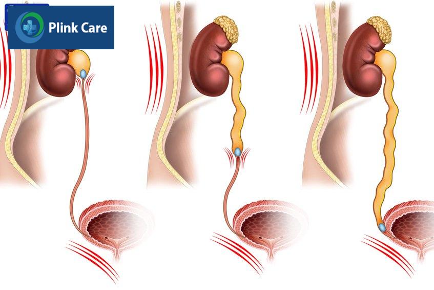 nhận biết cơn đau do sỏi thận