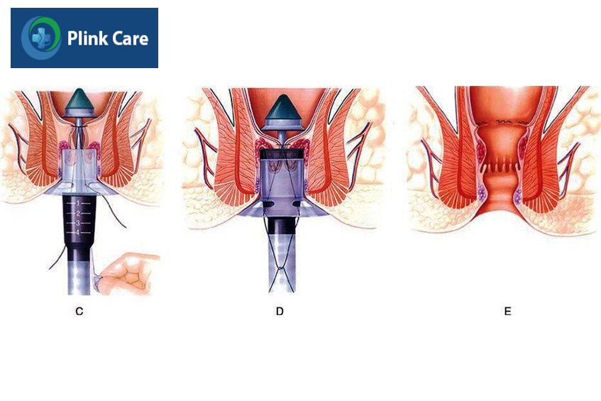 phương pháp chữa bệnh trĩ