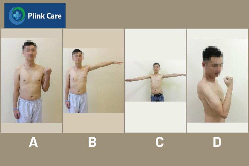 tổn thương rễ thần kinh đám rối cánh tay phải