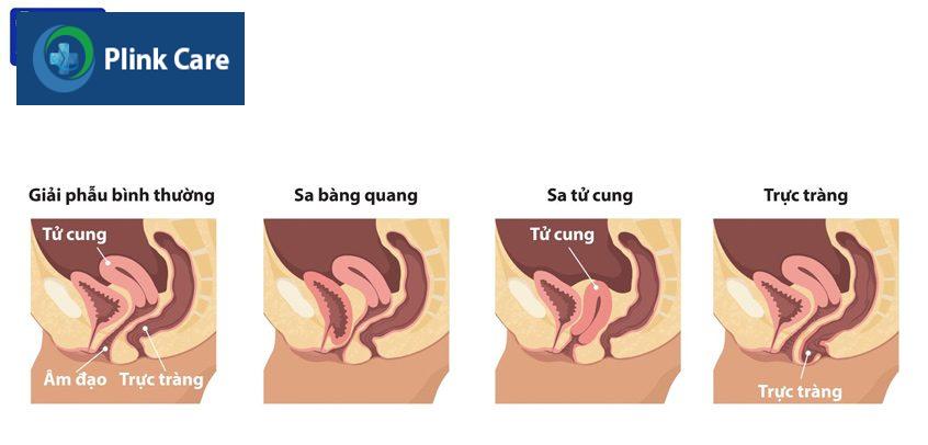 Cac loai sa tang vung chau