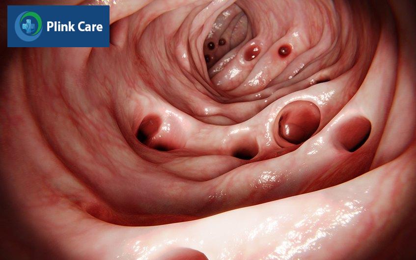 điều trị túi thừa đại tràng