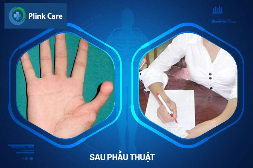 khau da co dinh nep bot