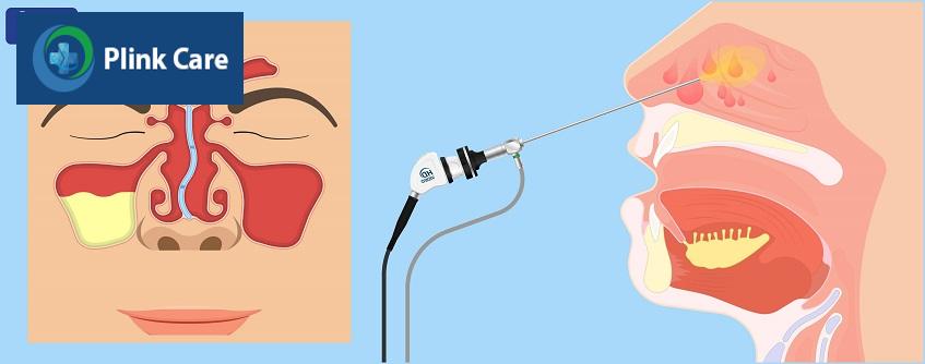 lệch vách ngăn mũi gây tắc nghẽn