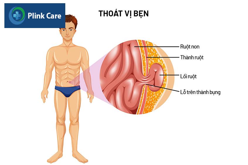 nguyên nhân gây thoát vị bẹn