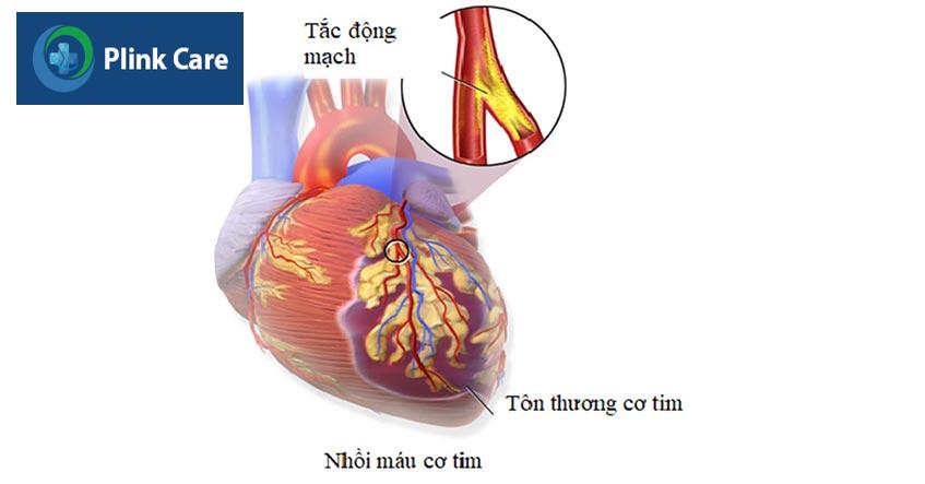 nhoi mau co tim la gi