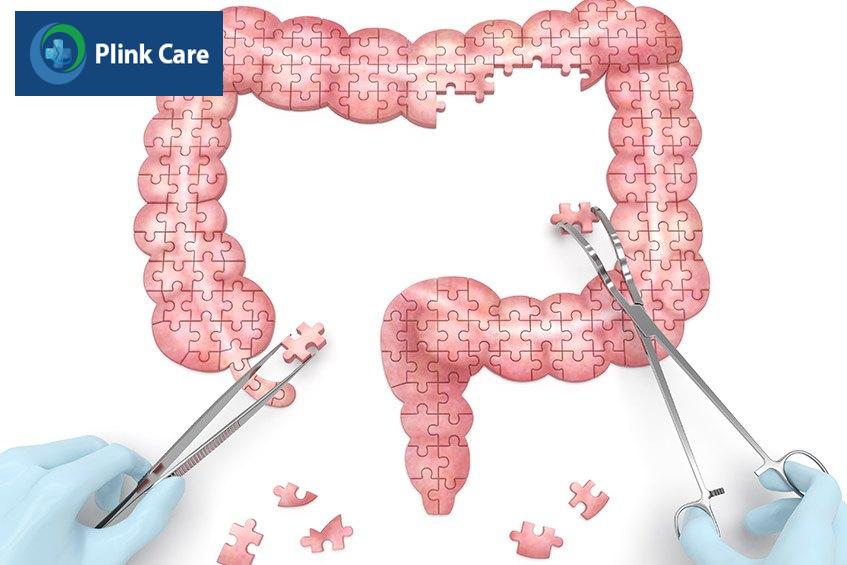 phẫu thuật cắt đại tràng trị ung thư