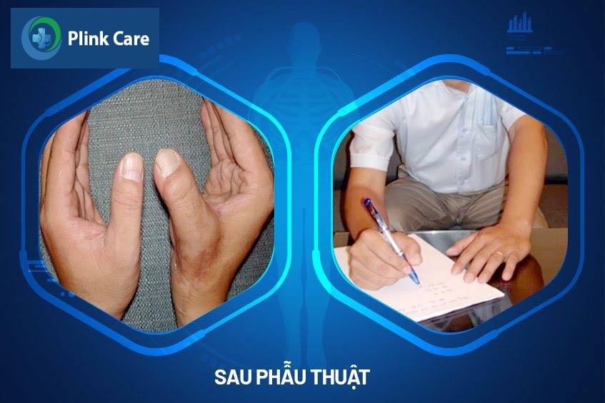 phuc hoi sau phau thuat chuyen ngon
