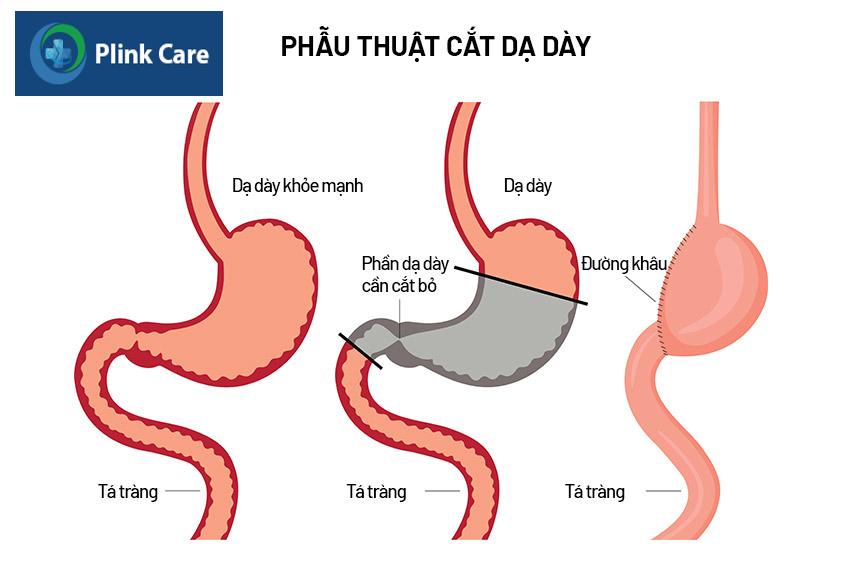 phương pháp phẫu thuật cắt dạ dày