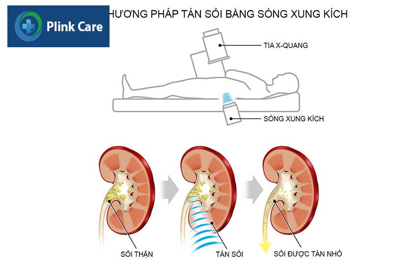 tan soi bang song xung kich