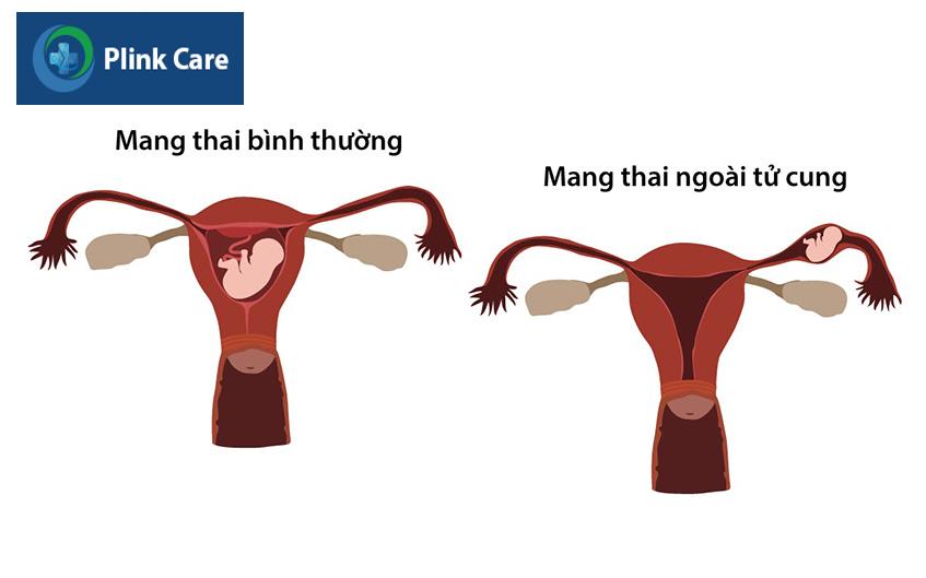 thai phat trien ngoai tu cung