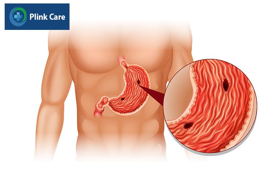 viêm loét dạ dày là gì?