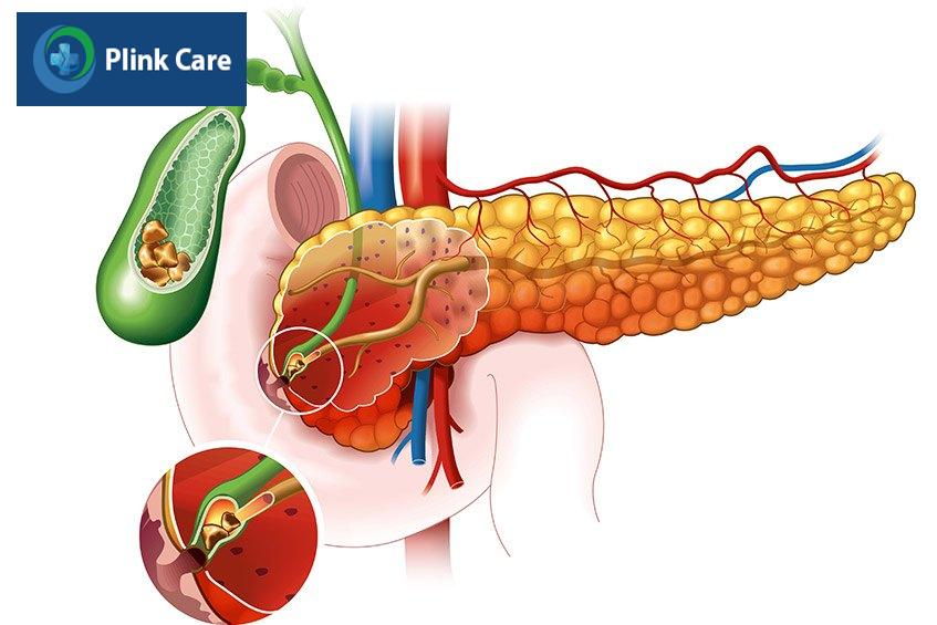 bệnh lý sỏi mật
