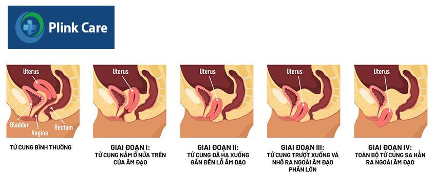 các giai đoạn bị sa tử cung