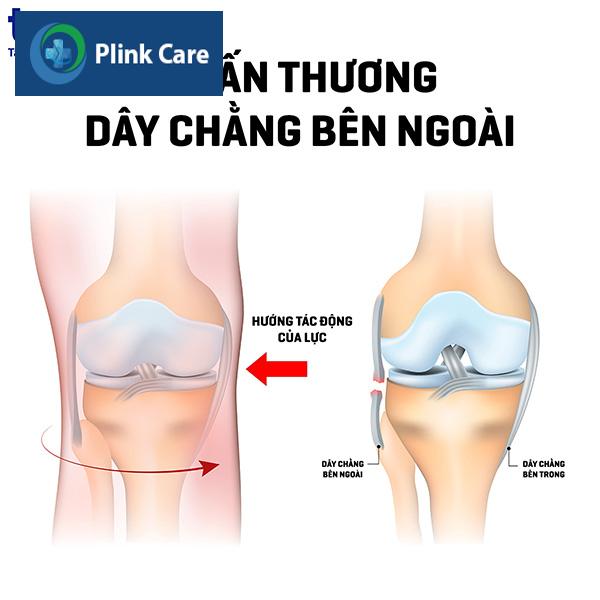 chan thuong dut day chang ben ngoai