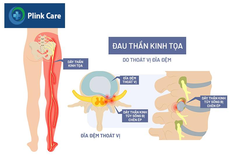 Đau thần kinh tọa