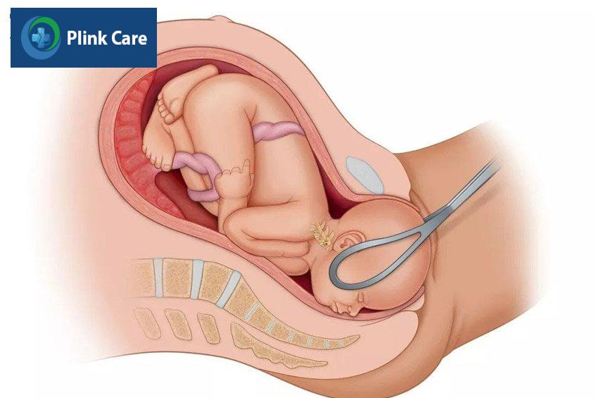 phương pháp forceps