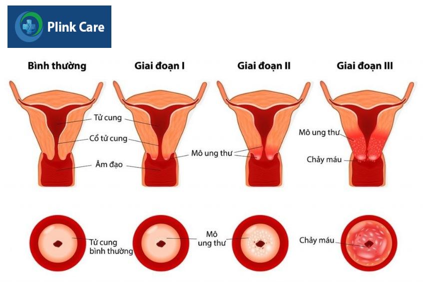 hình ảnh mô tả các giai đoạn của u cổ tử cung