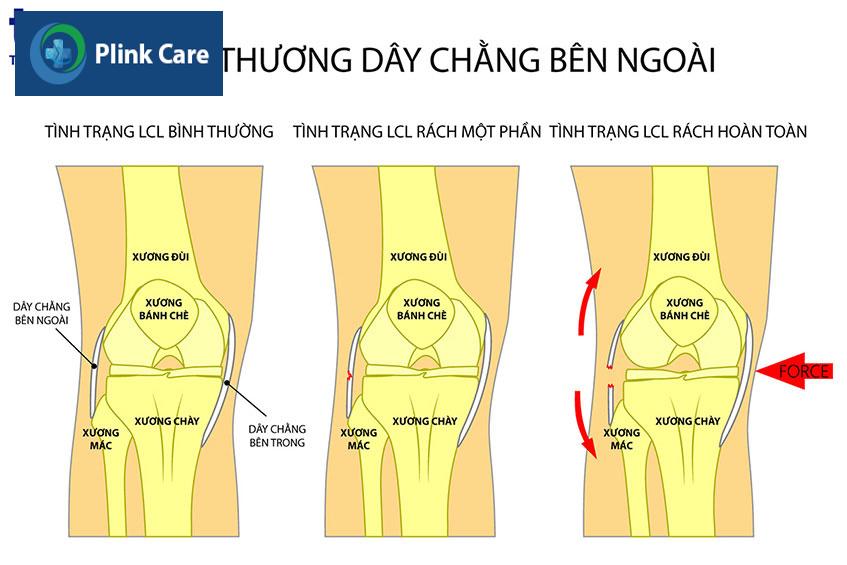 infographic đứt dây chằng bên ngoài