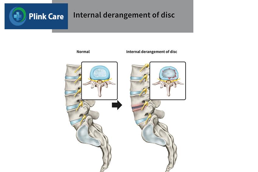 internal-derangement-of-disc