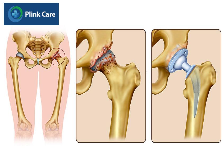 Thay khớp háng bán phần