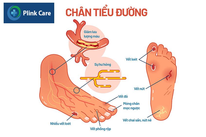 triệu chứng của biến chứng bàn chân do đái tháo đường